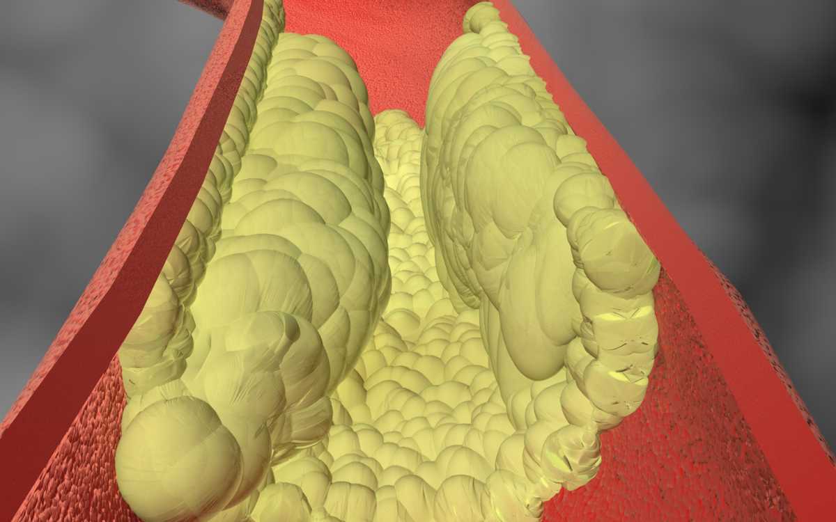 Penyumbatan pembuluh darah akibat penumpukan kolesterol (LDL).