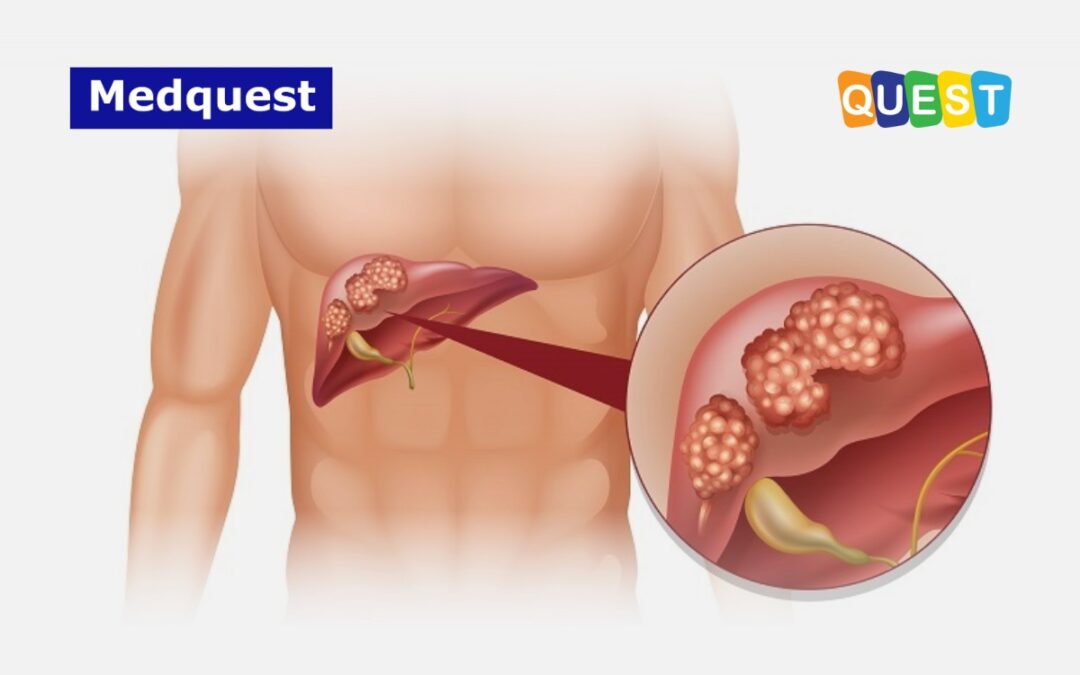 Karsinoma Hepatoseluler: Komplikasi Paling Berbahaya Fibrosis Hati