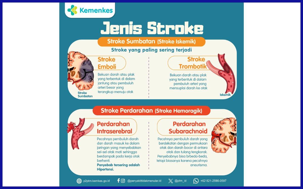 Jenis-jenis stroke berdasarkan penyebabnya
