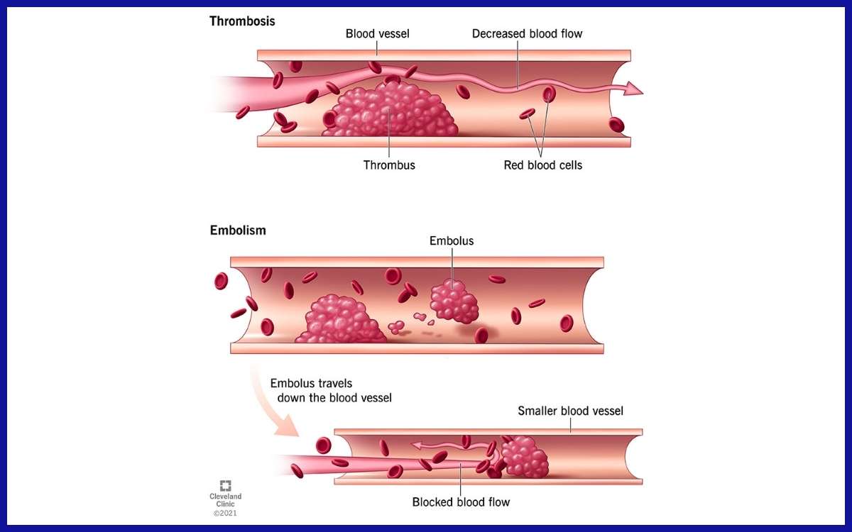 Ilustrasi Bagaimana Trombosis Dapat Menyebabkan Pembuluh Darah Tersumbat. Sumber: Cleveland Clinic.