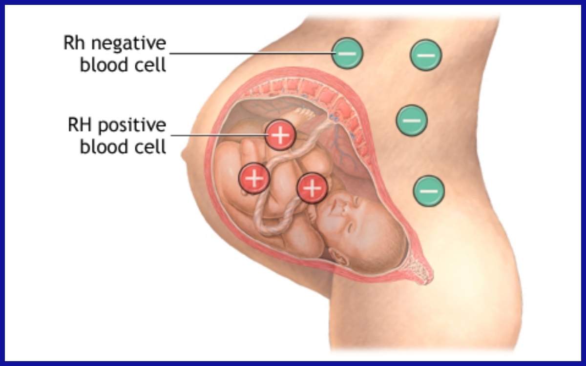 Ilustrasi Ibu Hamil dengan Rhesus Negatif dan Janin dengan Rhesus Positif