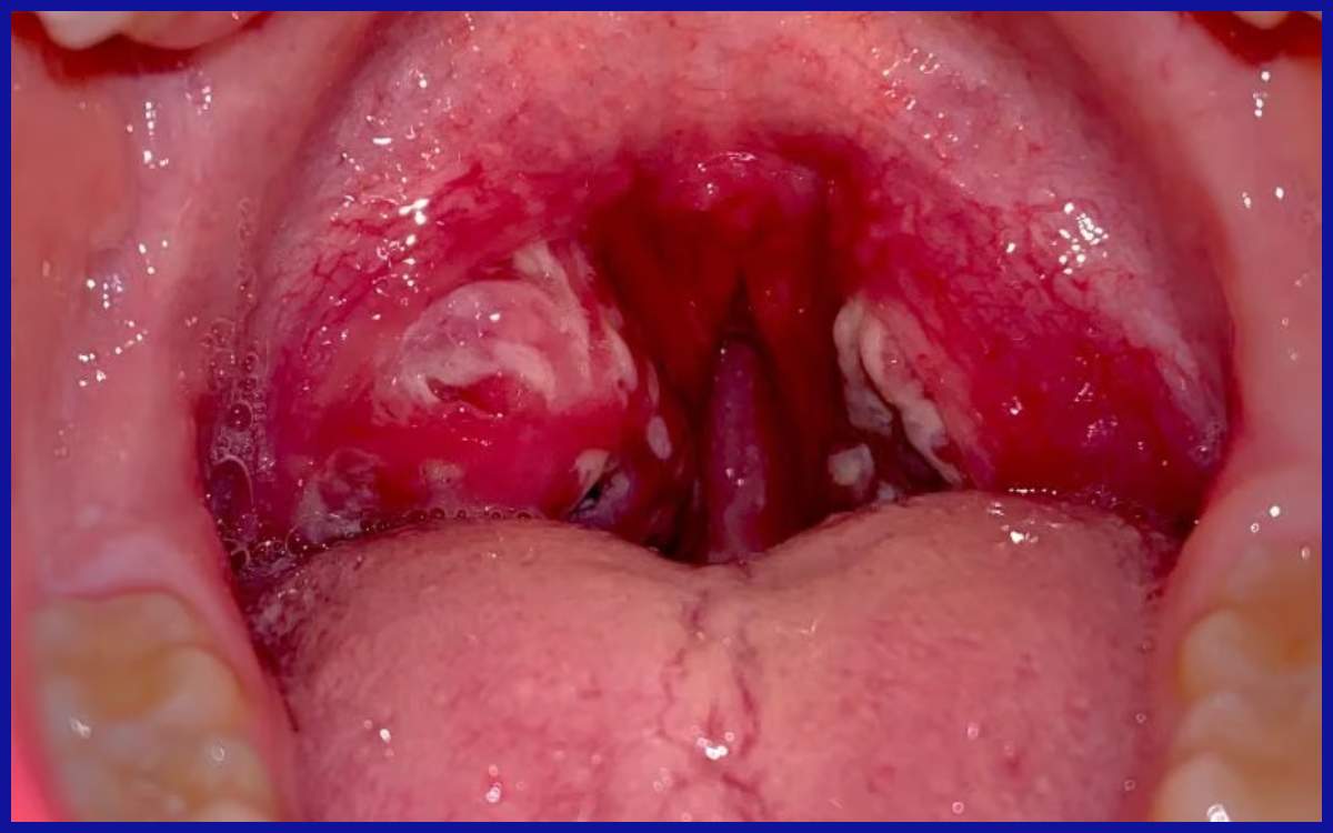 Faringitis akut, salah satu jenis ISPA