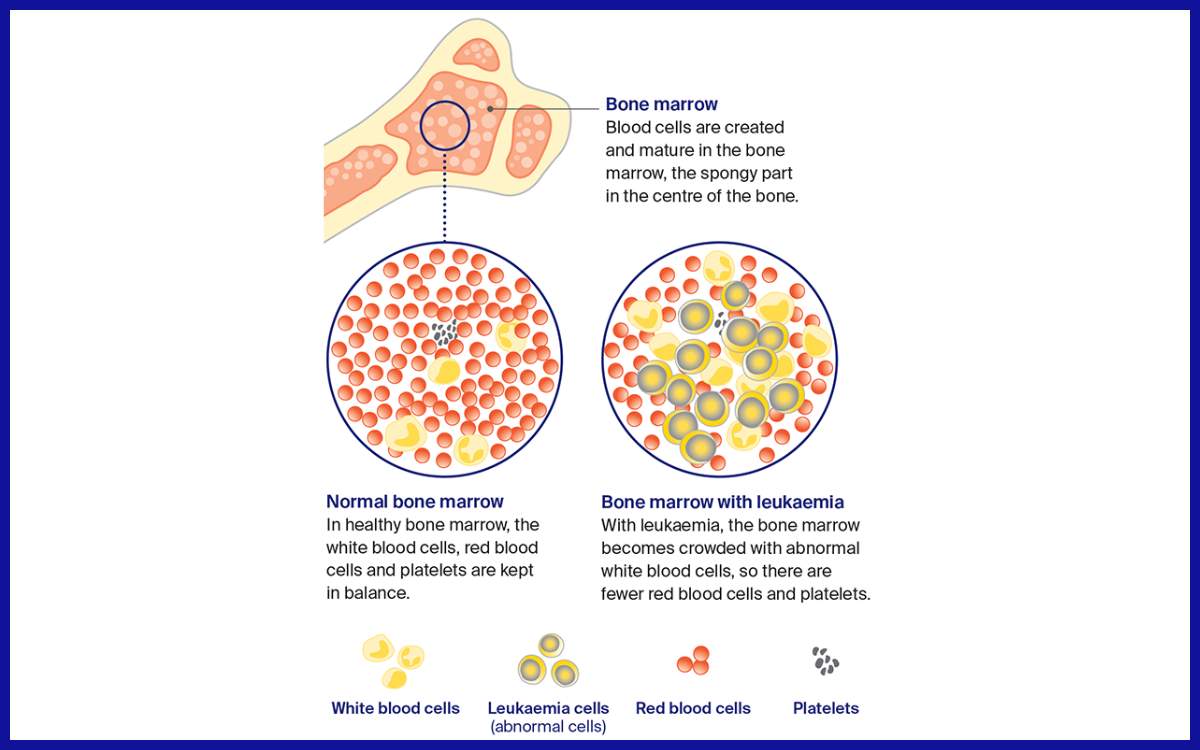 Perbandingan kondisi normal dan leukemia