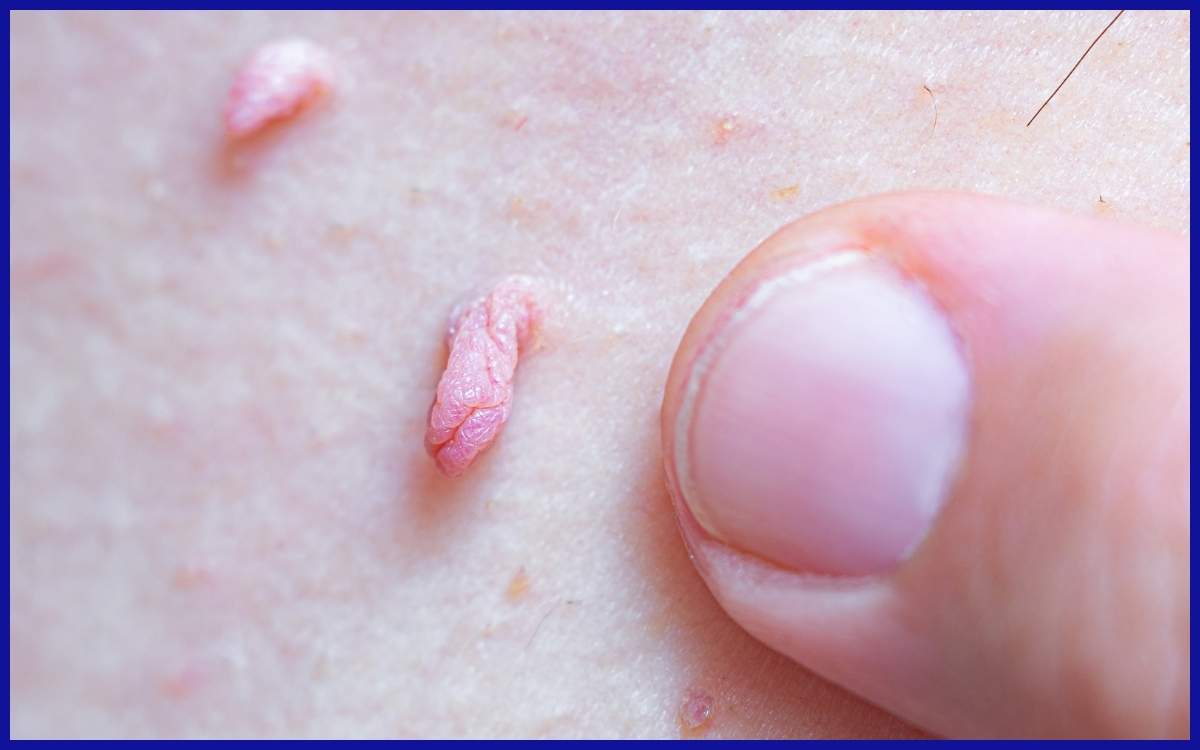 Gambar kutil pada kulit akibat hpv