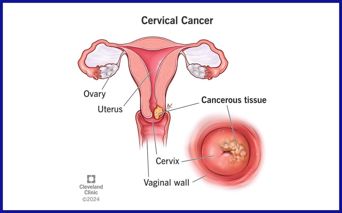 Kanker serviks, salah satu kanker yang diakibatkan oleh hpv