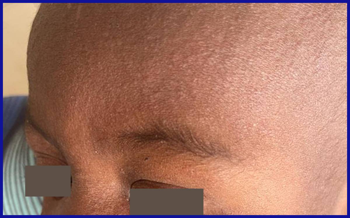 Contoh ruam campak pada tubuh manusia