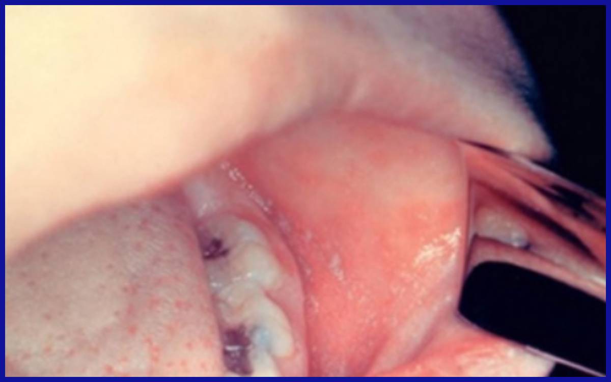 Koplik spot yang muncul pada penderita campak dapat menjadikan deteksi cepat untuk penegakan diagnosis