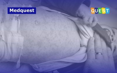 8.372 Kasus Campak dalam 8 Minggu: Apa yang Harus Diketahui Orang Tua Indonesia?