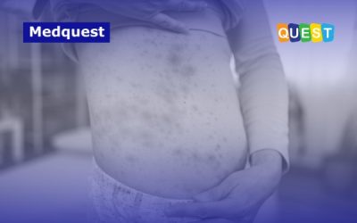 Penyakit Campak Kembali Mengancam: Fakta, Gejala, dan Data Lonjakan Kasus di Indonesia Tahun 2026