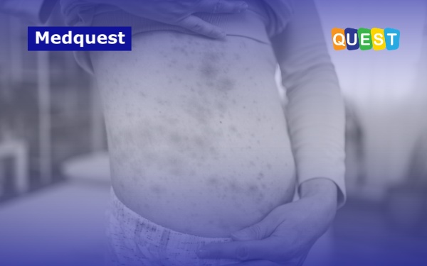 Penyakit Campak Kembali Mengancam: Fakta, Gejala, dan Data Lonjakan Kasus di Indonesia Tahun 2026